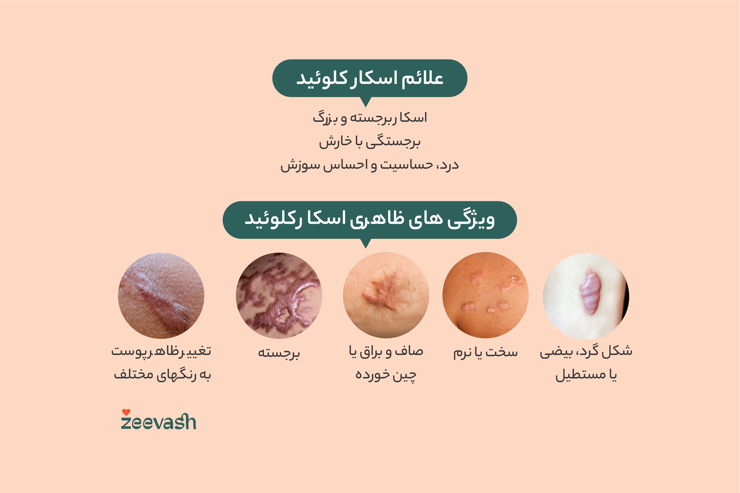 علائم و ویژگی های ظاهری اسکار کلوئید